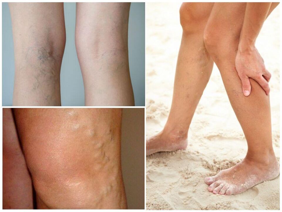 Simptomi varikoznih vena