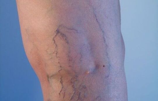 proširene vene na nogama kod žena