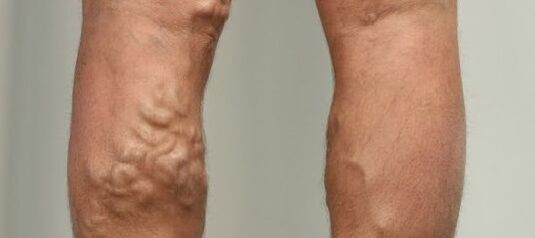 proširene vene na nozi