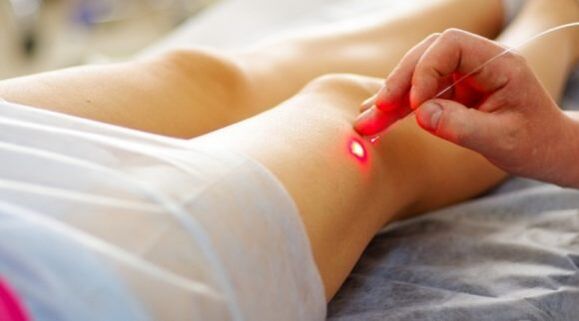 Laserska koagulacija varikoznih vena donjih ekstremiteta